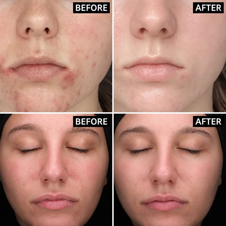 Beautyturess Sakura Essence Clarifying Acne Skincare Set (12pcs)